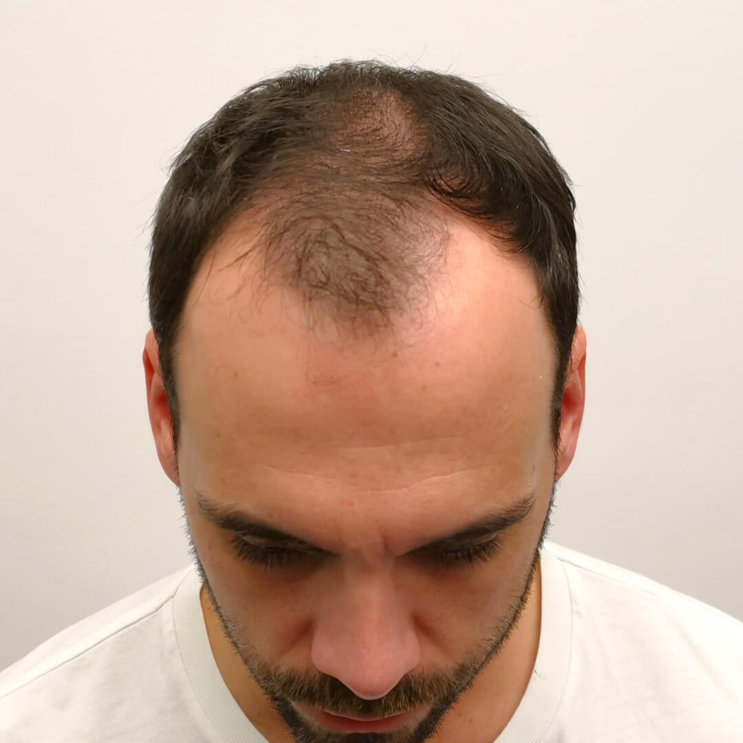 Hair Transplant before-after: Balázs - HIMG Hair Transplant Clinic Hair Transplant before-after: Balázs - HIMG Hair Transplant Clinic