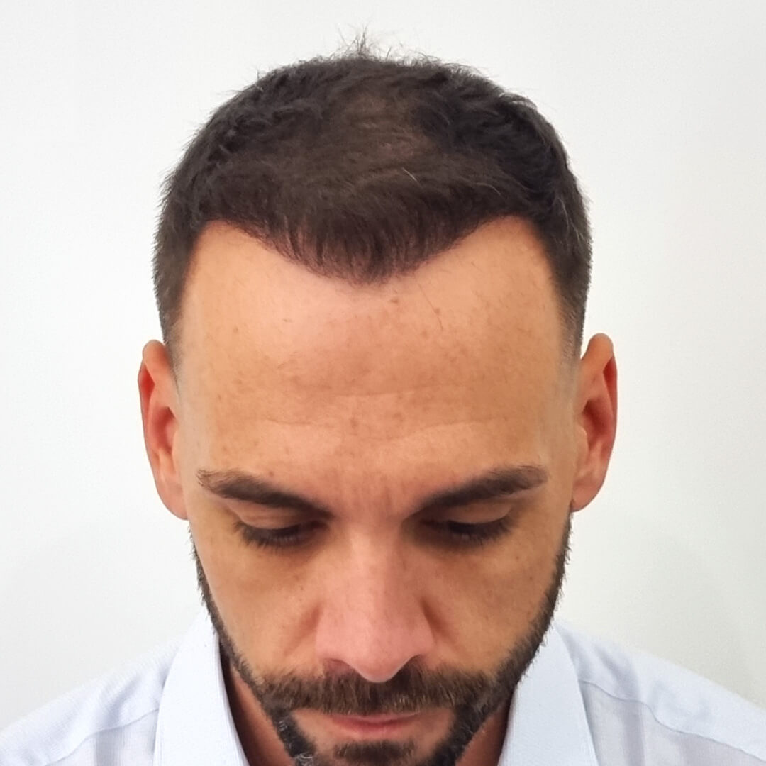 Hair Transplant before-after: Balázs - HIMG Hair Transplant Clinic Hair Transplant before-after: Balázs - HIMG Hair Transplant Clinic
