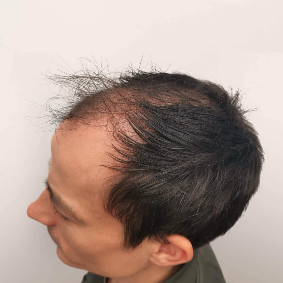 Hair Transplant before-after: Gergő - HIMG Hair Transplant Clinic Hair Transplant before-after: Gergő - HIMG Hair Transplant Clinic