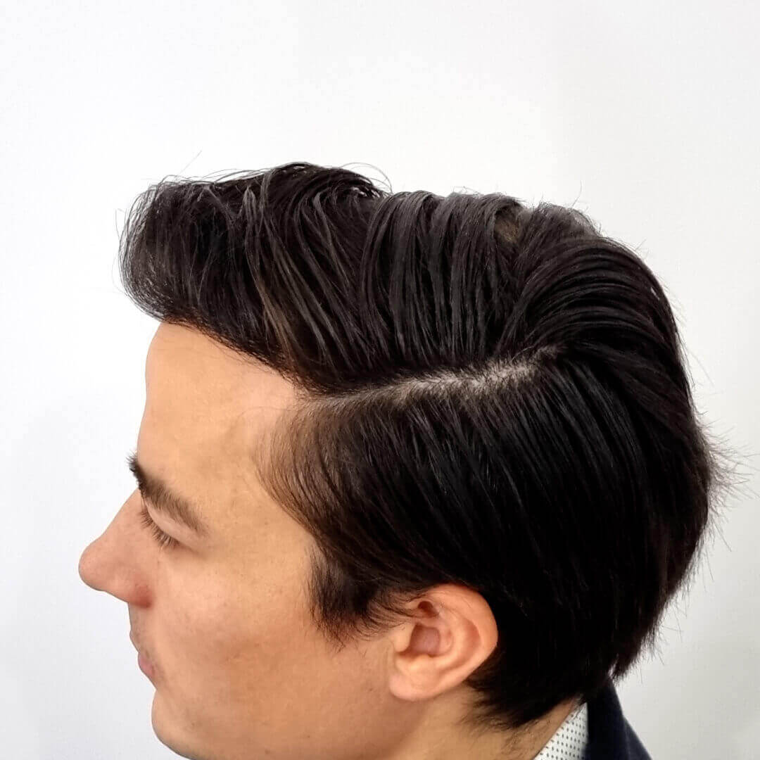 Hair Transplant before-after: Gergő - HIMG Hair Transplant Clinic Hair Transplant before-after: Gergő - HIMG Hair Transplant Clinic