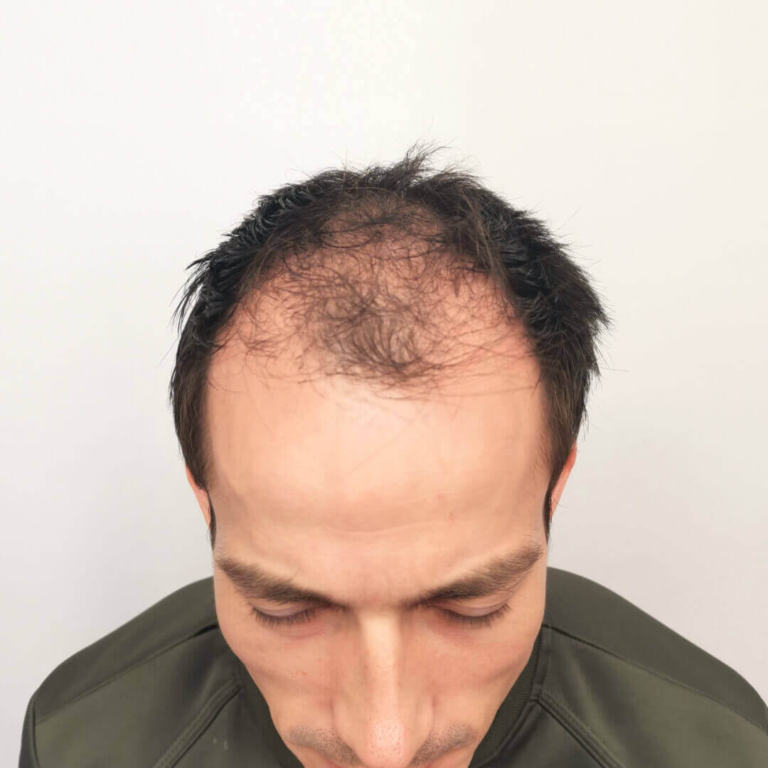 Hair Transplant before-after: Gergő - HIMG Hair Transplant Clinic Hair Transplant before-after: Gergő - HIMG Hair Transplant Clinic