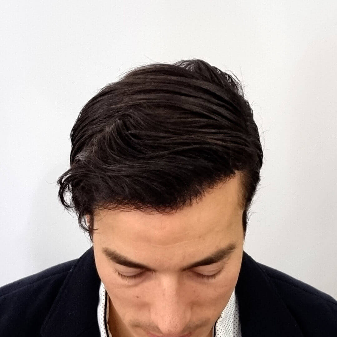 Hair Transplant before-after: Gergő - HIMG Hair Transplant Clinic Hair Transplant before-after: Gergő - HIMG Hair Transplant Clinic
