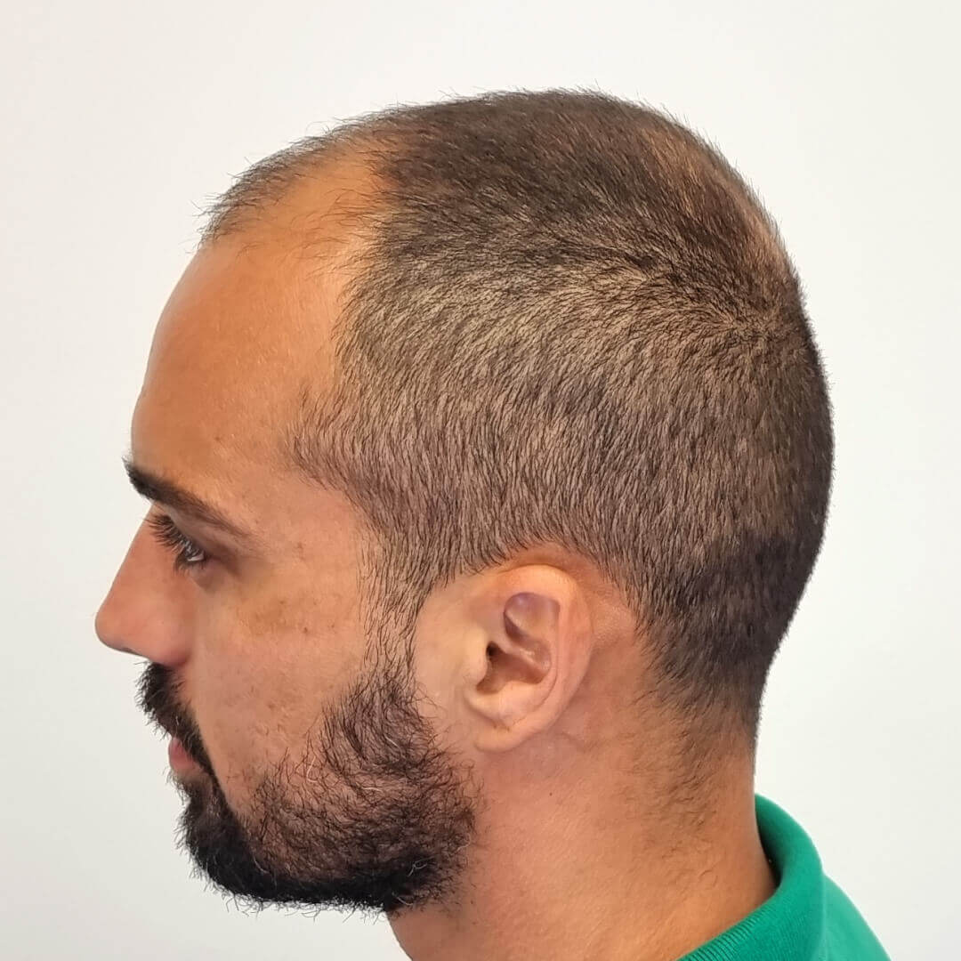 Hair Transplant before-after: Lucas M.D. Bertucci - HIMG Hair Transplant Clinic Hair Transplant before-after: Lucas M.D. Bertucci - HIMG Hair Transplant Clinic