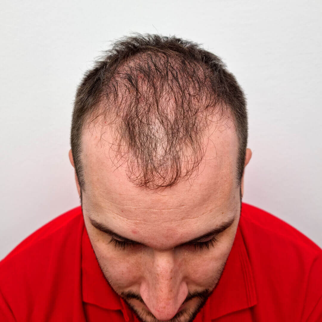 Hair Transplant before-after: Norbert Kiss - HIMG Hair Transplant Clinic Hair Transplant before-after: Norbert Kiss - HIMG Hair Transplant Clinic