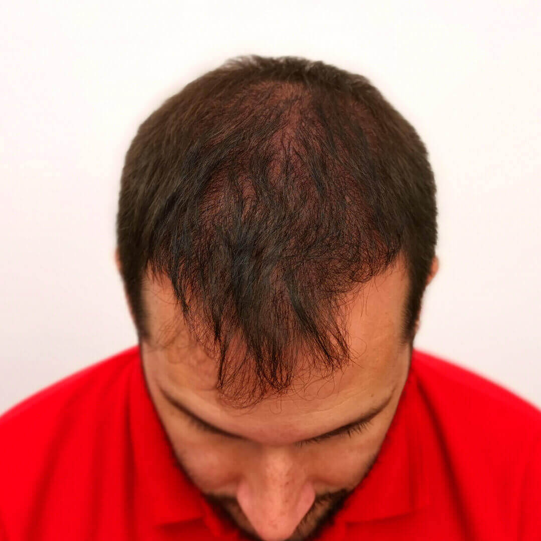 Hair Transplant before-after: Norbert Kiss - HIMG Hair Transplant Clinic Hair Transplant before-after: Norbert Kiss - HIMG Hair Transplant Clinic
