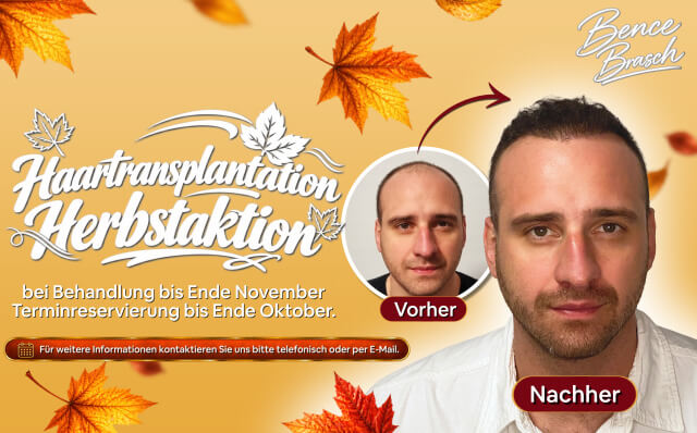 HIMG hajbeültetés akció